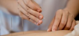 women getting acupuncture