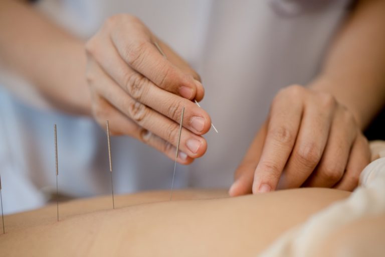 women getting acupuncture