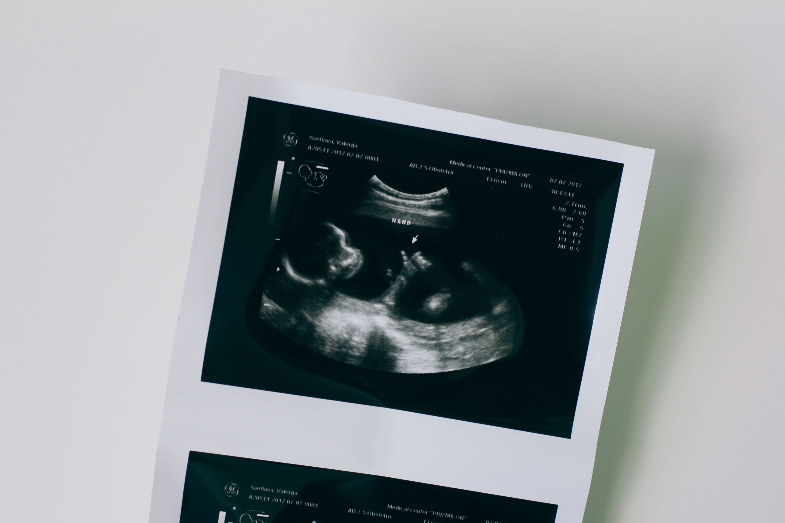 Ultrasound image